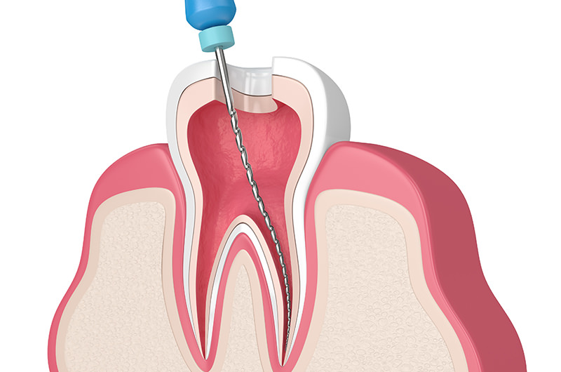 根管治療とは？